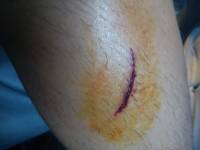 wound, injury