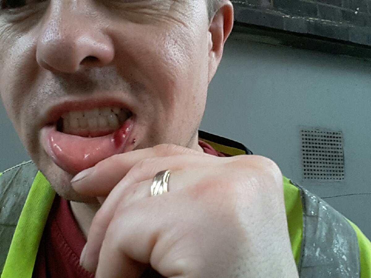 dont whack yourself in the mouth with a battery drill as this is what happens doh