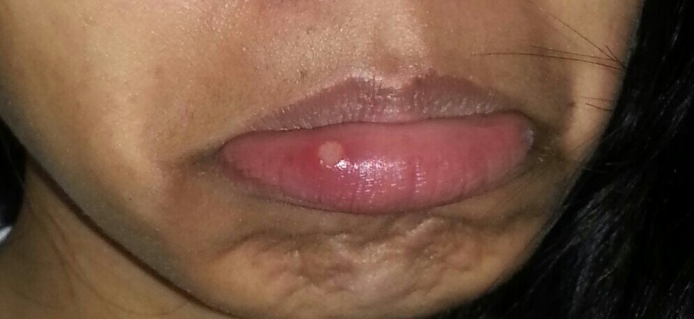 Got a mouth ulcer again, not just one but two 